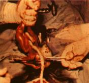 Аборт с помощью кесарева сечения